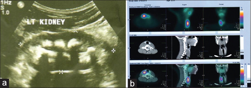 (a) Ultrasound showing bilateral medullary nephrocalcinosis (MNC) and (b) 99mTC myocardial perfusion imaging (MIBI) scan showing parathyroid adenoma