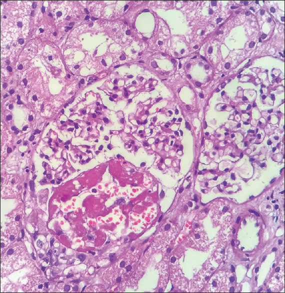 High-power view showing partial cellular crescents and tuft necrosis in the first kidney biopsy