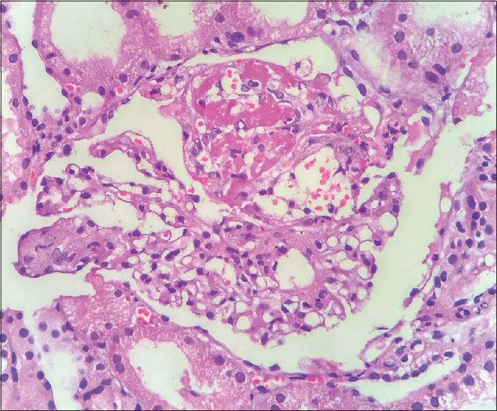 High-power view of second kidney biopsy showing tuft necrosis at 12 O' clock position