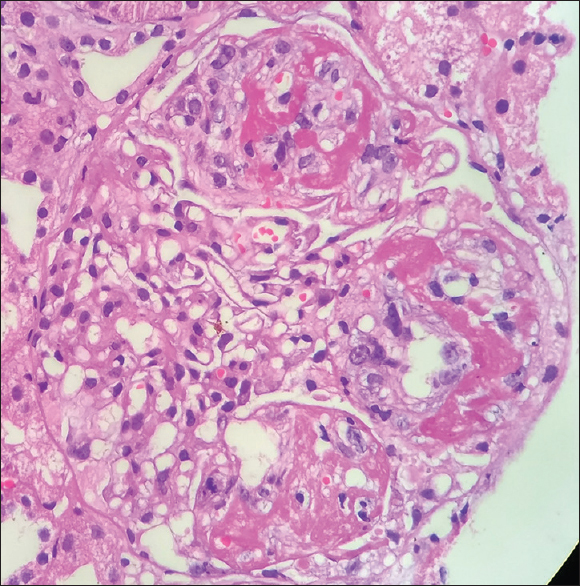 High-power view of crescentic GN at 9 O' clock position seen on the 2nd kidney biopsy