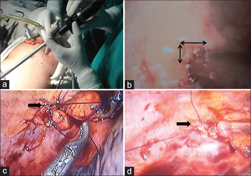 (a) Showing the procedure of video-assisted thoracoscopic ports and method; (b) identifying opening at diaphragm; (c) process of taking the suture around the opening defect; and (d) finally closure suture of the defect