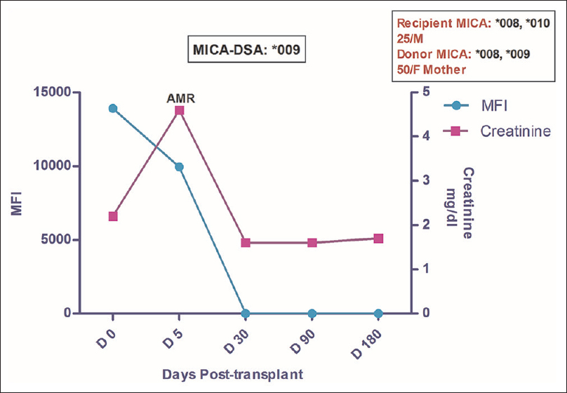 Longitudinal DSA analysis of case 1: Patient had DSA against MICA *009 at pre transplantation with MFI of 13907. No HLA-DSA was detected. Patient developed AMR (C4d–ve) on day 5 and MFI at that point of time fell down to 9945 with ↑ in creatinine to 4.6 from pre-transplant level of 2.2. The patient was treated for AMR which led to disappearance of MICA antibodies post treatment while the creatinine settled to a baseline value of 1.6. The patient was followed up to 16 months post-transplant and during this period no further rejection episode was observed
