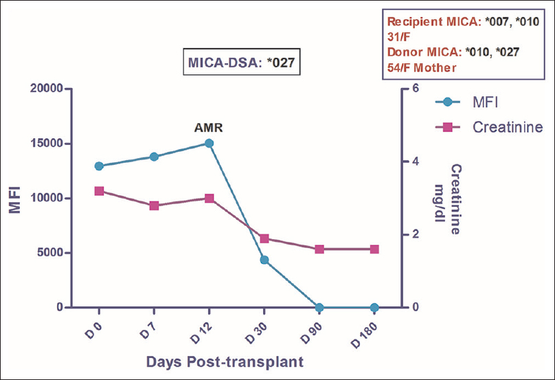 Longitudinal DSA analysis of Case 2: The patient had DSA against MICA*027 at pre transplantation with MFI of 12945. She developed AMR on POD 12, was treated successfully for the same which led to disappearance of MICA antibodies by day 90 while the creatinine settled down to a baseline value of 1.6. No further rejection episode was observed till the post-transplant follow-up period of 23 months