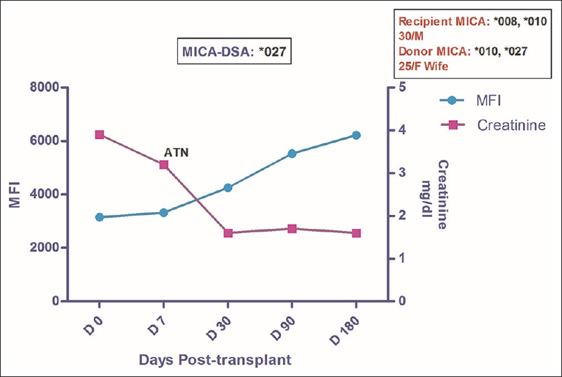 Longitudinal DSA analysis of Case 3: The patient had DSA against MICA*027 at pre transplantation with MFI of 3151. He developed ATN on day 7 with a slight ↑ in MFI to 3325. Creatinine on day 7 was 3.2 which settled down to a baseline value of 1.6. No rejection episode was seen till the post-transplant follow-up of 18 months. No HLA-DSA was detected in this patient