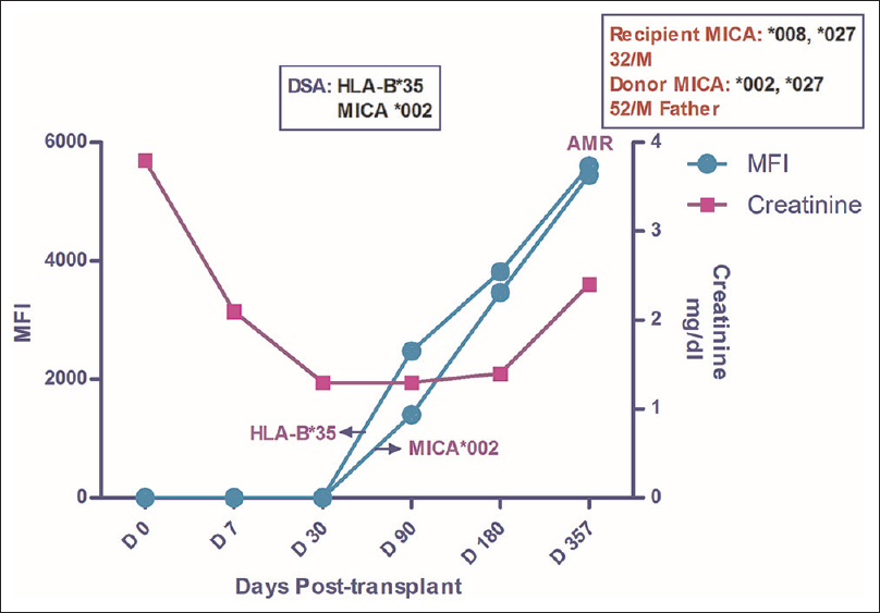 Longitudinal DSA analysis of Case 5: Patient had no HLA or MICA antibodies at pre transplant stage. DSA to HLA-B*35 and MICA*002 was first detected on D 90 with MFI of 2475 and 1403 respectively. The MFI values kept on increasing till POD 357 when he developed AMR (C4d+). At the time of diagnosis of AMR, the MFI values for HLA and MICA DSA were 5406 and 2381 respectively. Ultimately the graft was lost in this patient. Creatinine at the time of first detection of DSA was 1.3 which rose to 2.4 when the biopsy was done