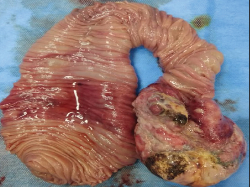 A large growth measuring 8.5 × 06 × 2 cm is seen at one end of resected jejunal loop which is projecting into lumen. The lining mucosa is focally ulcerated