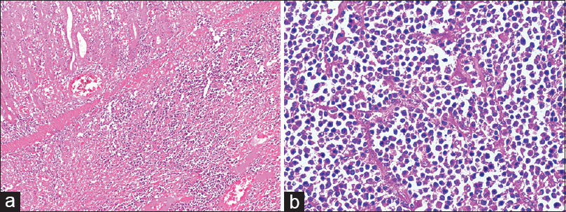 (a) The Hematoxylin and Eosin (H and E; 100×) sections from the tumor mass showed a normal mucosal lining with infiltration of underlying submucosa by sheets of large monomorphic atypical lymphoid cells having immunoblastic morphology. (b) At 400 × magnification individual tumor cells have large vesicular nucleus with prominent nucleoli and eosinophilic cytoplasm. Interspersed are seen numerous plasma cells with frequent binucleate forms
