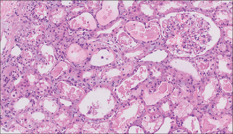 Renal biopsy showing the terminal tubules having granular eosinophilic focally lamellate, PAS negative, and fractured cast with sloughing of tubular epithelium. Interstitium showed edema, focal collections of lymphocytes, and few neutrophils with mild areas of fibrosis