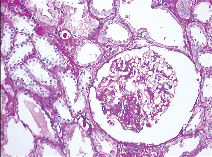 Light microscopy of a renal biopsy from a patient with Class III lupus nephritis. The glomerulus reveals focal sclerosing glomerulonephritis and focal hypercellularity. Periodic acid–Schiff, magnification 200×