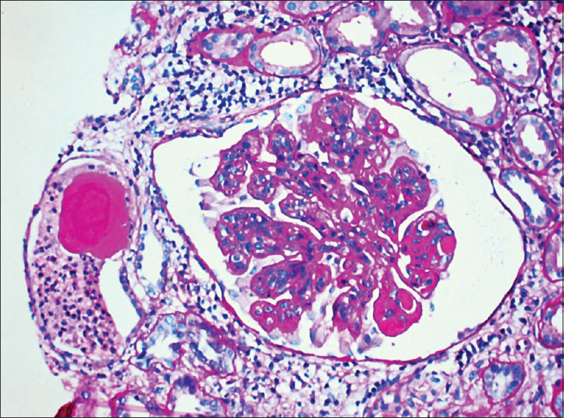 Light microscopy of a renal biopsy from a patient with Class IV lupus nephritis. The glomerulus showing hyaline thrombi, dilated capillary lumina, and mild mesangial hypercellularity. (a) Periodic acid–Schiff, magnification 400×