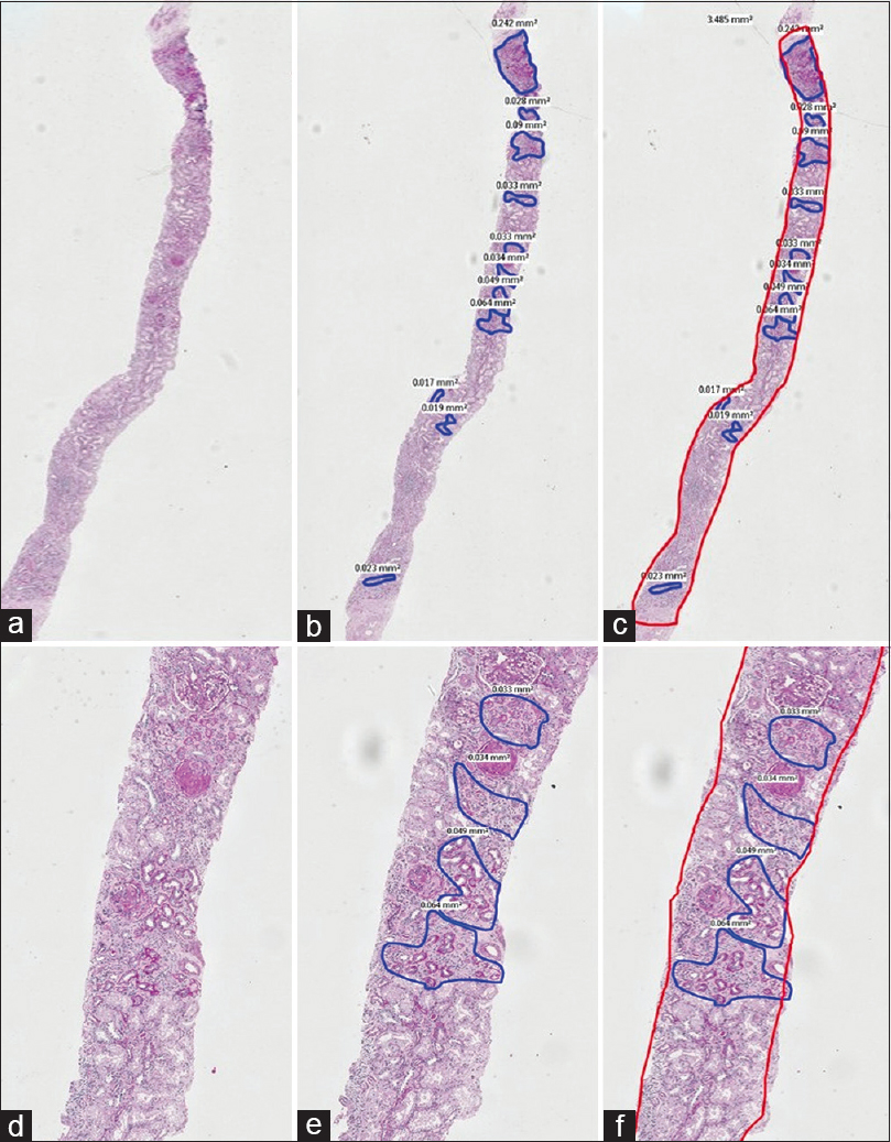 A composite picture of PAS stained sections at low (2X) and high (10X) magnification annotated similar to Figure 1. Here, the atrophy on ‘eyeballing’ was estimated at 30% whilst that by digital measurement was only 18.13%