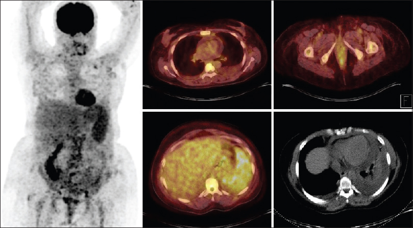 Whole-body 18-F-fluorodeoxyglucose (FDG)–positron emission tomography/computed tomography at the admission revealed hepatosplenomegaly, the spleen with heterogeneous increased FDG uptake (SUVmax: 6.4), left submandibular, right subclavicular, bilateral axillary, left para-aortic, and bilateral inguinal hypermetabolic lymph nodes, and there was a view compatible with nonmetabolic effusion in the pericardial and bilateral pleural area