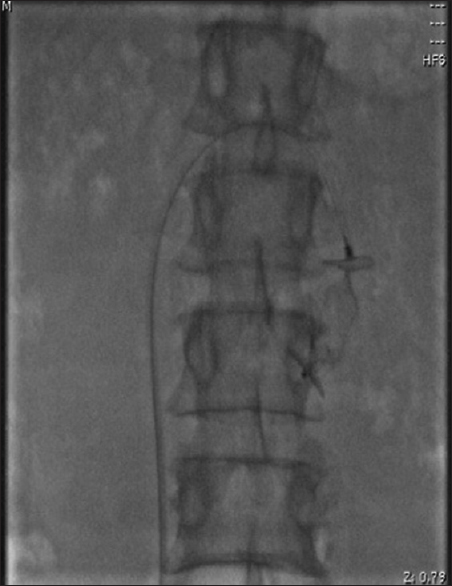 Fluoroscopic image just after deploying Amplatzer vascular plug