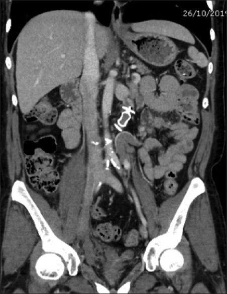 CECT abdomen after embolisation of the portal-systemic shunt using Amplatzer vascular plug