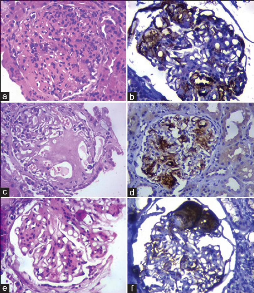 a. MPGN showing global endocapillary proliferation (H and E, 400X) b. C4d deposits along the thickened glomerular capillary wall in MPGN (IHC, 400X) c. Enlargement of glomerulus with deposition of amorphous eosinophilic material in the mesangium and along capillary walls in amyloidosis. (H and E, 400X) d. Deposition of C4d in mesangium and along capillary walls in amyloidosis (IHC, 400X) e. Nodular diabetic glomerulosclerosis showing Kimmelstiel–Wilson nodule (H and E, 400X) f. Bright deposition of C4d in diabetic nodule (IHC, 400X)