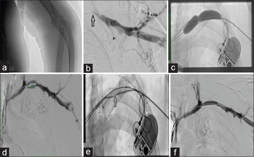 Left brachiobasilic AVF with left upper limb edema (a). DSA angiogram was taken (b) showing severe subclavian vein stenosis (arrow) with multiple venous collaterals (COL). Balloon angioplasty was attempted,however there was waist on balloon[resistant stenosis] (c). Post angioplasty angiogram showed significant residual stenosis(>30%) (d). Self expandable metallic stent (ST) was then deployed across the stenosis with the waist persistent (arrow), however final angiogram (e and f) showed minimal (<30%) stenosis wit no opacification of venous collaterals. P- Pacemaker apparatus