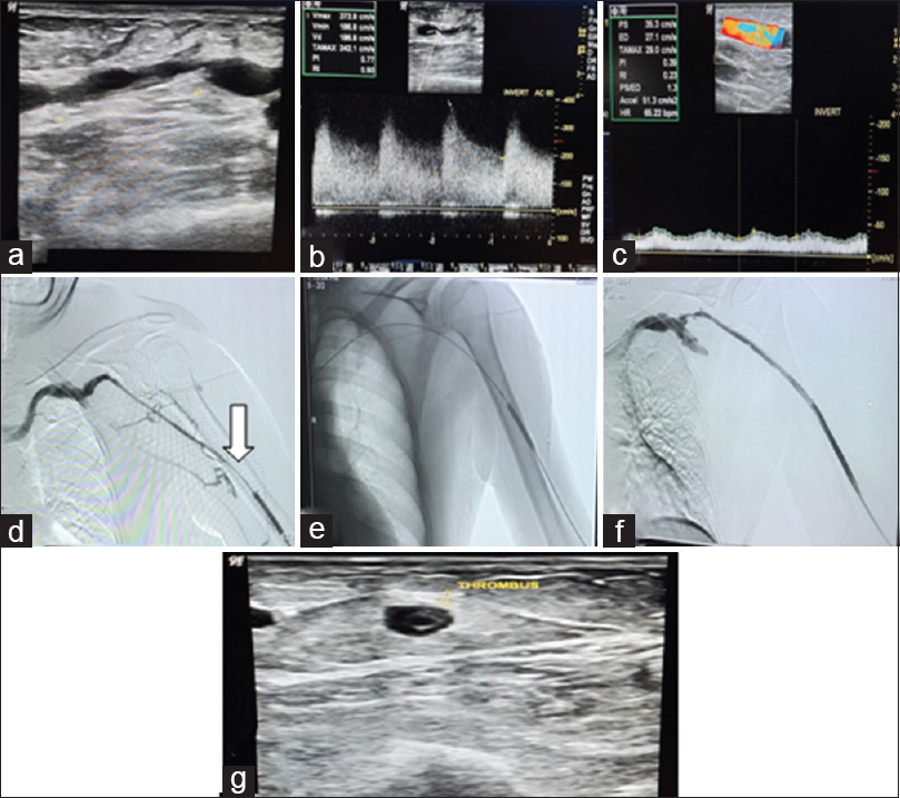 Left brachiocephalic AVF with decreased thrill. Long segment stenosis in draining was seen on USG (a) with aliasing and high PSV (373.8cm/s) at stenotic site (b) and inadequate flow in draining vein (app. 110 ml/min) (c).DSA venogram confirming the long segment stenotic site (>4 cm) (arrow in d). Balloon angioplasty was done at multiple sites (e). Final angiogram after PTA showing no residual stenosis (f). Partial thrombosis of draining vein (g) was seen on the immediate USG after procedure (24 hours) which progressed to complete thrombosis causing failure