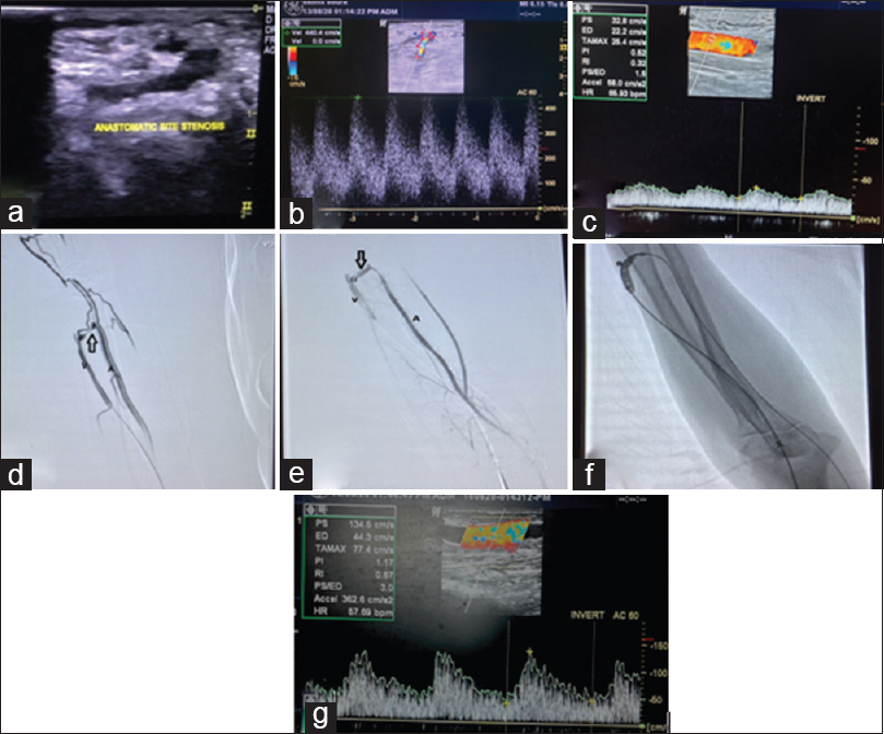 Left distal RC AVF referred in view of inadequate flow with decreased thrill. Anastomotic site stenosis was seen on screening USG (a) with aliasing and high PSV (440cm/s) at stenotic site (b) and inadequate flow in draining vein (app. 150 ml/min) (c). DSA Venogram confirming the stenotic site (arrow in d). Angioplastic balloon was then placed across the stenosis and fully inflated (e) and final angiogram was obtained after PTA with no residual stenosis (arrow in f). Follow up USG showing adequate flow in draining vein (app. 550 ml/min) (g). V-draining Vein, A- Supplying Artery