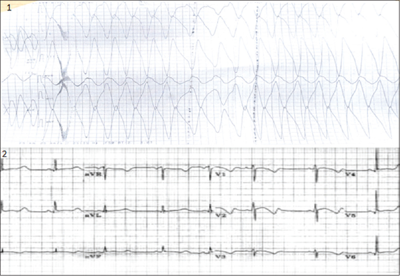 ECG of case 2, 1. showing Ventricular tachycardia and 2. showing prolonged QTc interval