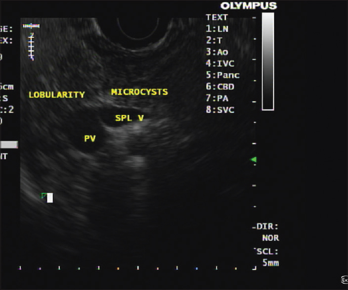 Endoscopic ultrasound image showing lobularity of pancreatic parenchyma and microcysts indicative of early changes consistent with chronic pancreatitis