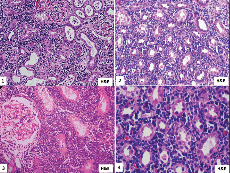 Kidney biopsy showing interstitial involvement by small to medium-sized atypical lymphoid cells. H and E, 1 is ×10, 2 and 3 is ×200, 4 is ×400