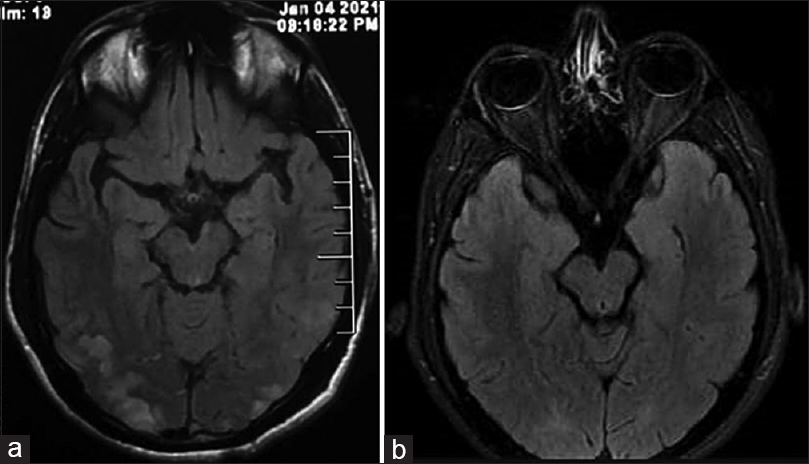 (a) Follow-up images done after 10 days show complete resolution of the cord findings. (b) Follow-up images done after 10 days show a significant reduction in the sub-cortical hyperintensities