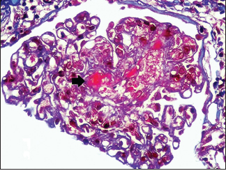 Fibrin thrombi seen occluding the capillary lumen (MT 400x, RENOPATH, Chennai)