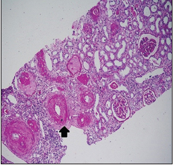 Fibrin thrombi seen occluding the arterioles, with fibrous intimal proliferation (PAS 100x. RENOPATH, Chennai)