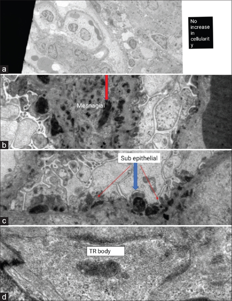 Electron microscopy showing (a) no increase in cellularity (total magnification 2.00kx), (b) subepithelial electron-dense deposits (total magnification 8.00kx), (c) mesangial electron-dense deposits (total magnification 10.00kx), and (d) tubulo-reticular body (total magnification 50.00kx)