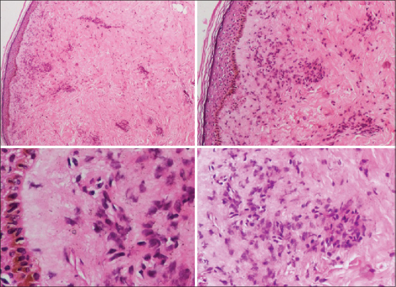 Vasculopathic lymphoid infiltrate with focal panniculitis