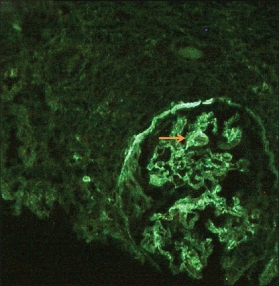 Linear immunofluorescence on IgG (++) staining along the glomerular capillary walls interrupted by coarse granularity at foci (arrow)