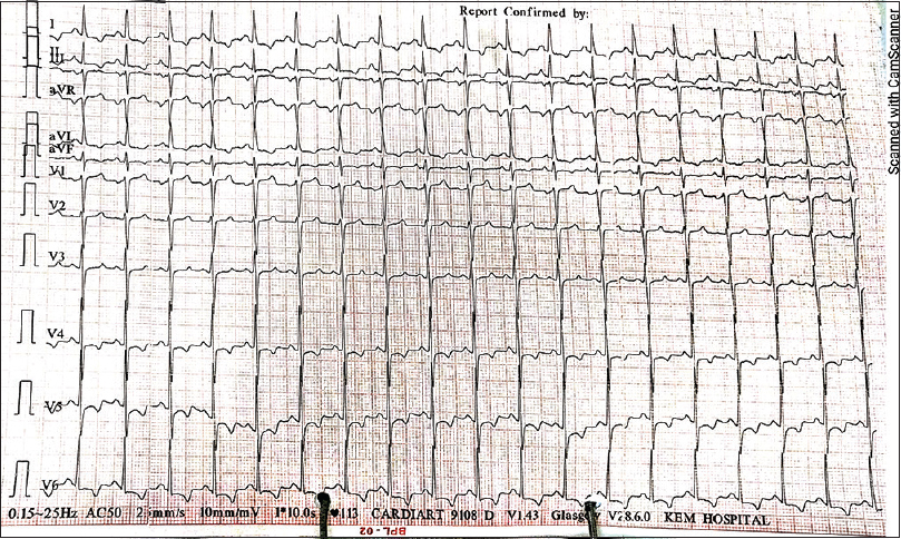 Electrocardiogram (ECG) findings of Case 4: new ST segment depression and T wave inversion in I, aVL, V4–V6