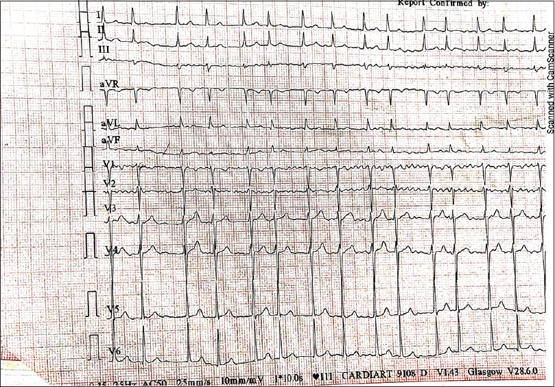 Electrocardiogram (ECG) findings of Case 5: atrial fibrillation