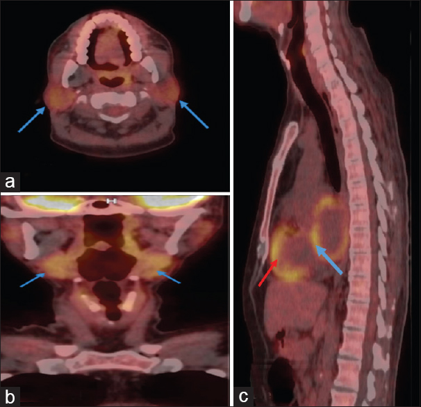 (a and b) depict diffuse fluorodeoxyglucose (FDG) uptake (blue arrows) in the parotid and submandibular glands, respectively, suggestive of sialadenitis. (c) shows normal FDG uptake in the left ventricle (red arrow) as compared with abnormal uptake in the left atrium (blue arrow) suggestive of myocarditis