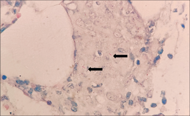 Bone marrow trephine biopsy reveals positive staining for acid-fast bacilli as indicated by black arrows (Ziehl-Neelsen stain, x400)