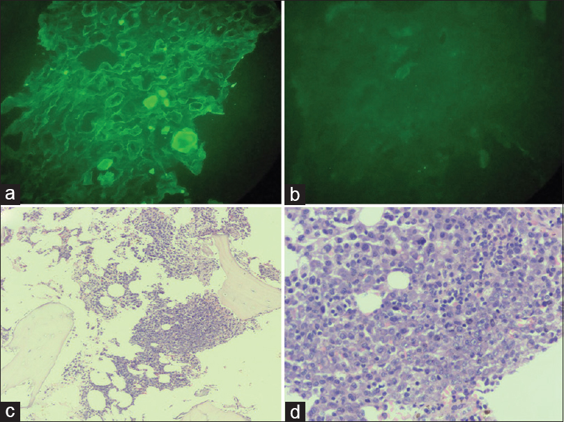 (a and b) Immunofluorescence microscopy shows lambda chain restriction and Kappa chain negative in fractured tubular casts (Lambda and Kappa × 200); (c) Bone marrow biopsy nodular aggregates of plasma cells (H&E × 100); (d) Sheets of plasma cells admixed with scattered mature lymphocytes (H&E × 400)