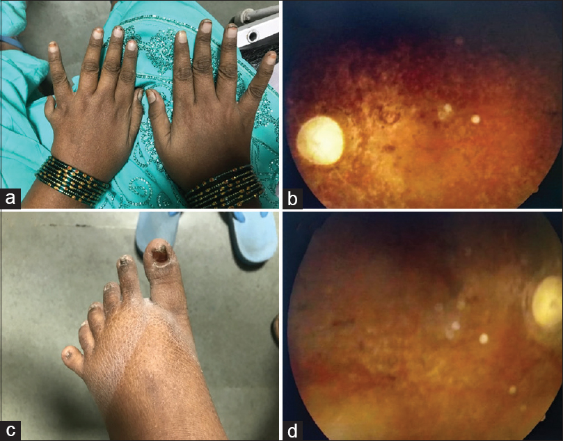 (a) Hexadactyly in the left hand (b) Retinitis Pigmentosa on fundoscopy (c) Hexadactyly in lower limb (d) Retinitis Pigmentosa on fundoscopy