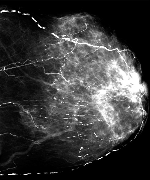 Diagnostic mammogram demonstrating extensive linear branching vascular calcifications with additional distinct tissue calcifications throughout the left breast.