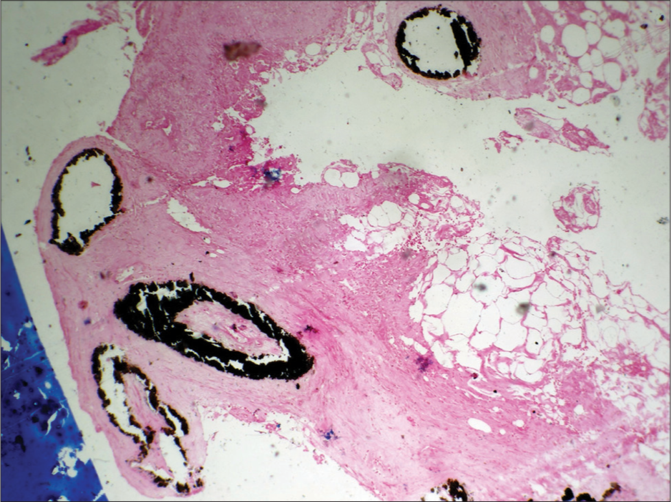 von Kossa stain showing deposits of calcium within dermal vessel wall.