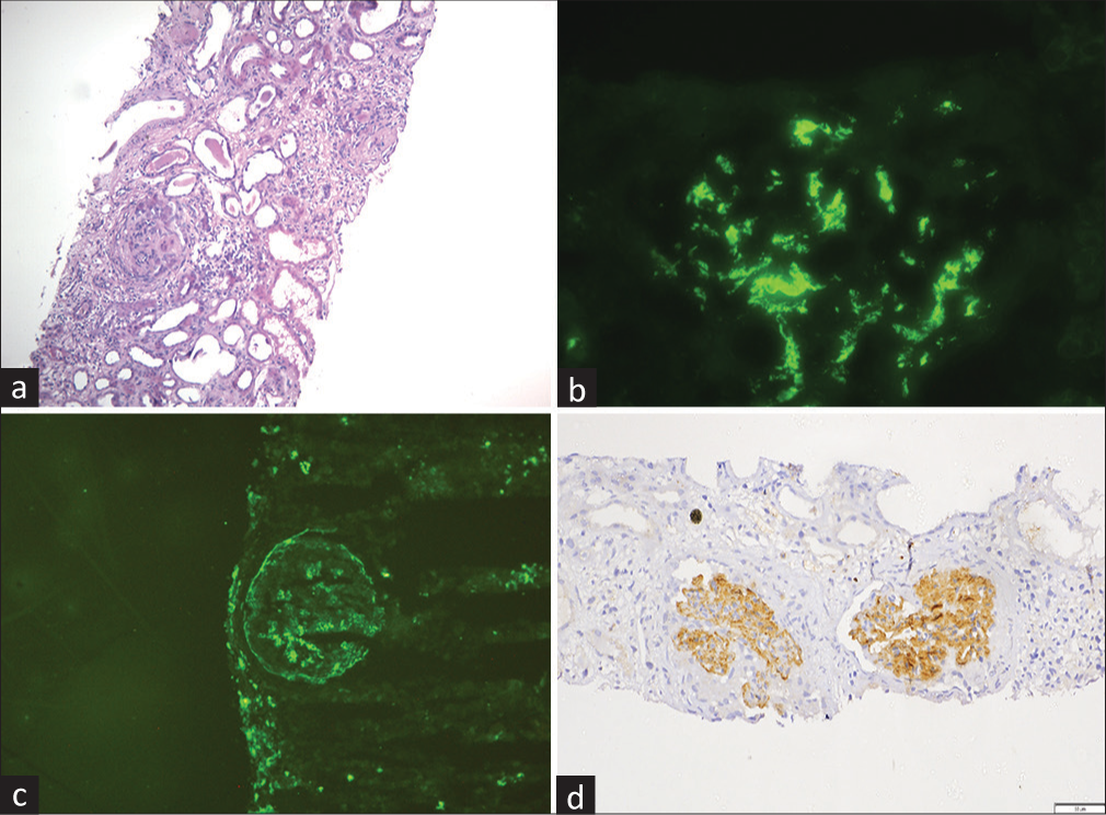 (a) Two completely sclerosed glomeruli with mild interstitial mononuclear inflammatory cell infiltrate (light microscopy, H and E stain, 10×). (b) Intense IgA deposition in the mesangium and in the capillary walls (immunofluorescence, IgA antiserum, 40×). (c) IgG deposition in the mesangium and in the capillary walls (immunofluorescence, IgG antiserum, 40×). (d) Immunohistochemistry shows bright staining for DNAJB9 in the mesangium and the capillary walls (immunohistochemistry, 20×), DNAJB9 = DnaJ heat shock protein family (Hsp40) member B9, H and E = hematoxylin and eosin.