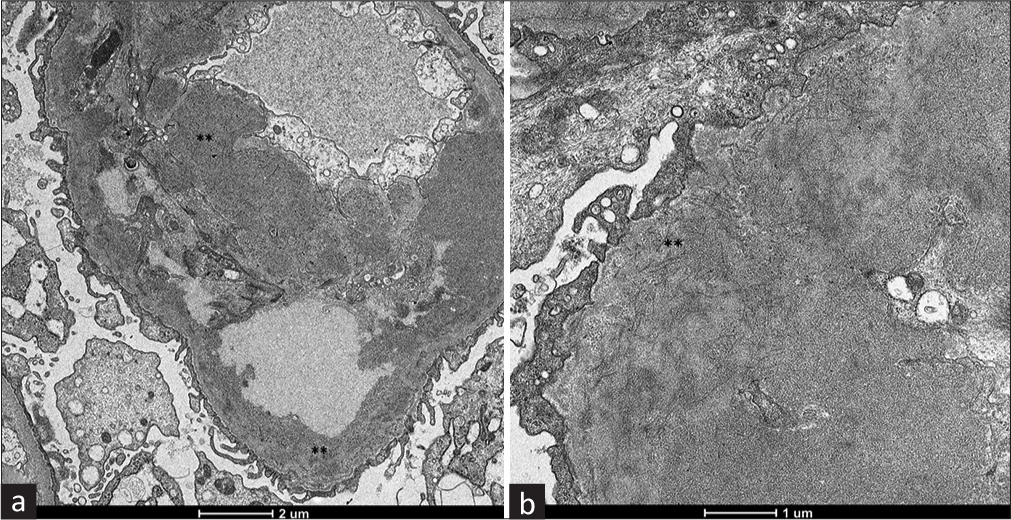 (a) Electron-dense deposits located in the basement membrane and mesangium (**). (electron microscopy, 2600×). (b) Mesangial deposits composed primarily of short and rigid fibrils without a hollow core, with a diameter ranging between 10 and 23 nm (**), contained in dense fine granular material (electron microscopy, 8500×).