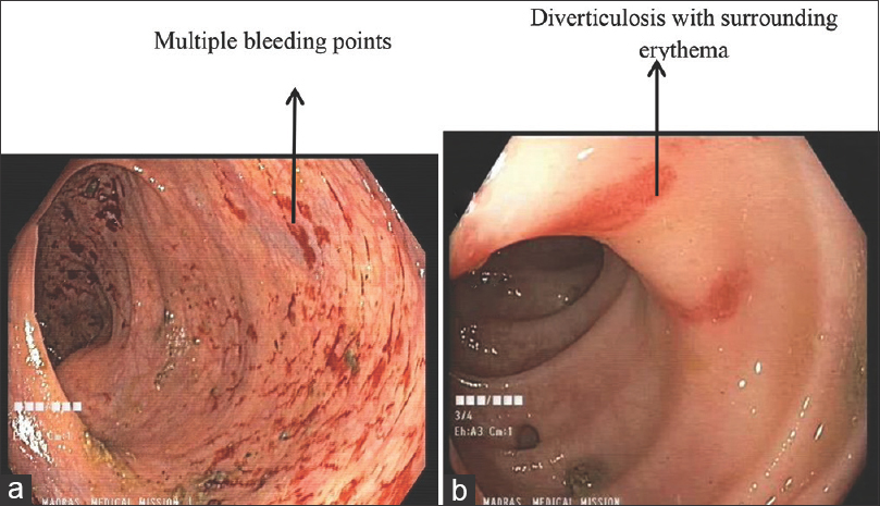 Colonoscopy