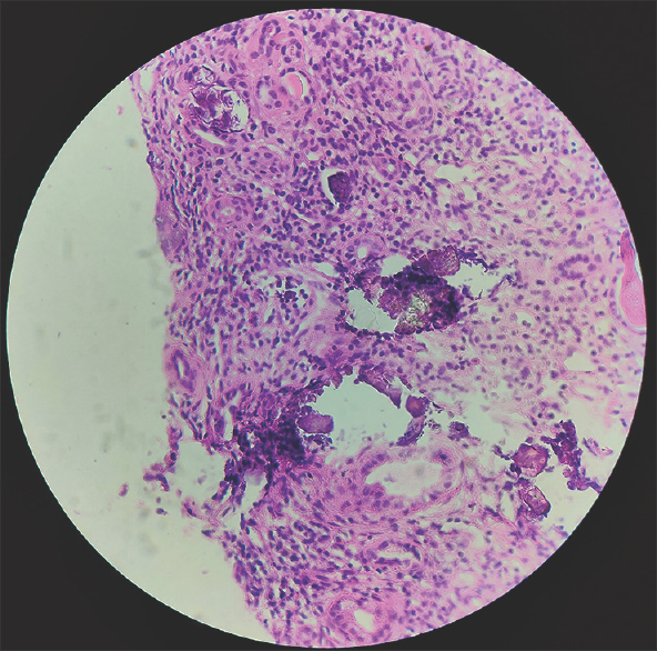 Interstitial inflammation comprising of lymphocytes and plasma cells with multiple foci of intratubular calcification (Hematoxylin and Eosin stain, magnification: ×100)