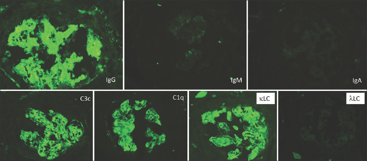 Composite immunofluorescence panel showing strong positivity for IgG, C3, and C1q as prominent mesangial smudgy deposits and around the capillary loops. There is light chain restriction with strong κ light chains and negative λ light chains (FITC-labeled antibodies 200×)