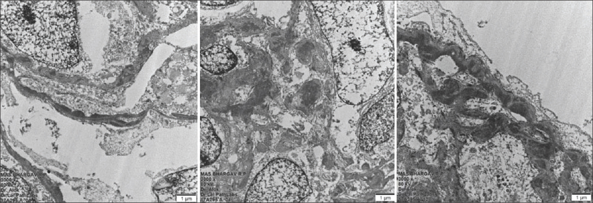 Electron microscopy showing mesangial electron-dense granular deposits in the subendothelial location (left panel) and mesangial location (middle panel). The right panel shows subendothelial deposits and diffuse foot process effacement (3000×)