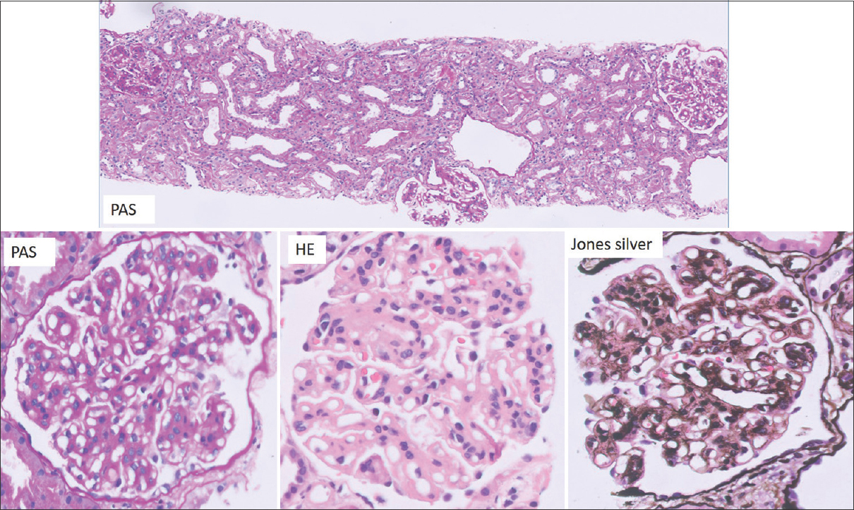 The top panel shows two hypercellular glomeruli with an unremarkable tubule-interstitium (PAS 100×). The bottom panel shows the glomerulus with a mesangial hypercellularity and an irregular thickening of the basement membrane with focal double contours (400×)