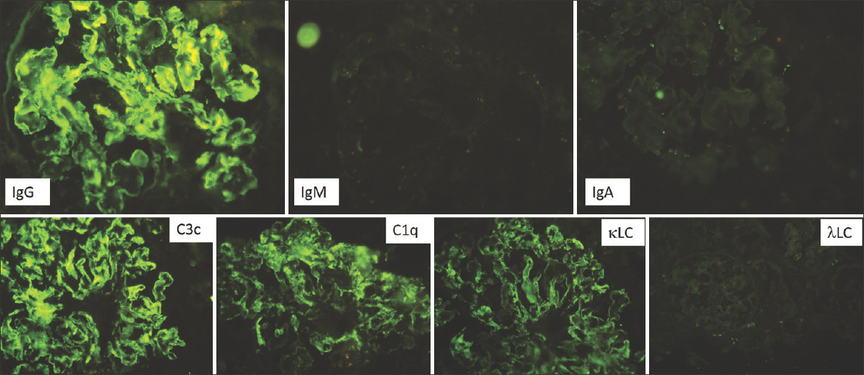 Immunofluorescence of the allograft biopsy showing strong staining for IgG, C3c, and C1q with kappa light chain restriction, similar to that seen in the native kidney (FITC- labeled antibodies 200×)