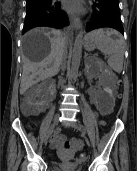 Coronal CT scan plain abdomen showing polycystic appearance involving both kidneys and liver