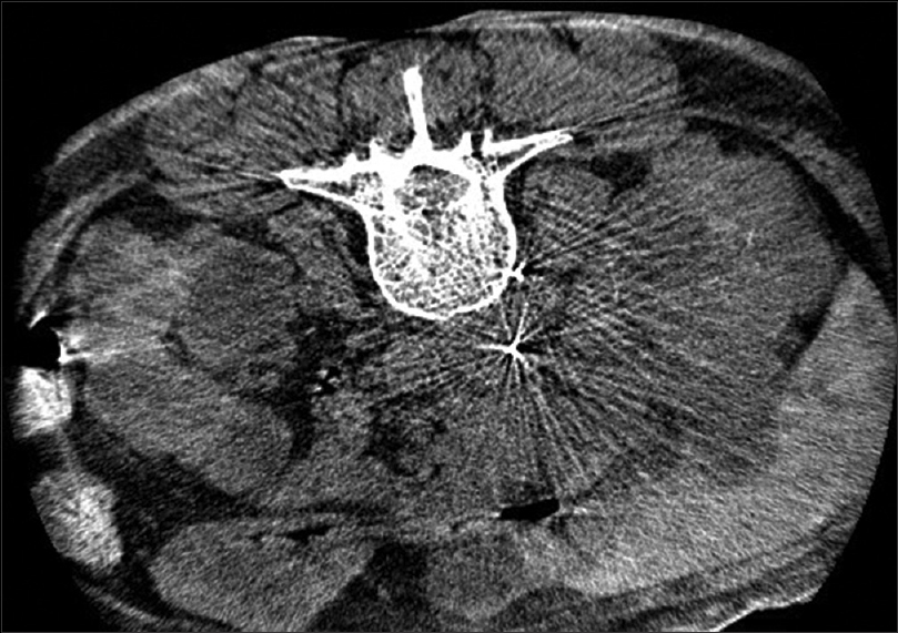 Dyna CT scan plain abdomen showing the tip of Chiba needle within the IVC