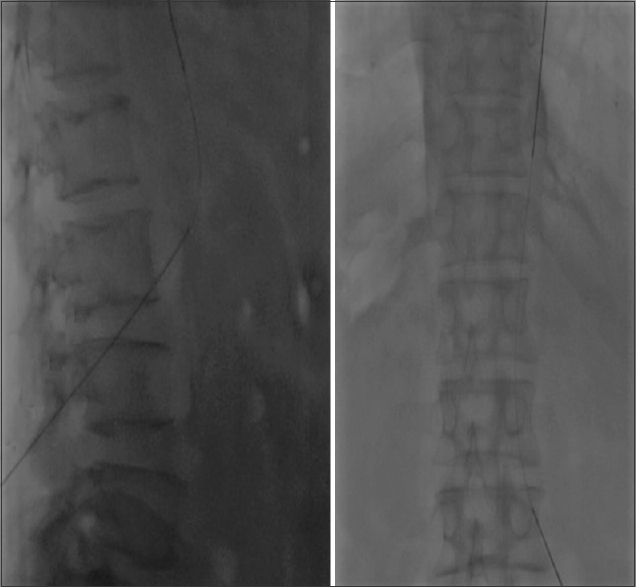 AP and lateral fluoroscopy image showing the tip of Chiba needle at the level of L3 vertebral body with wire within the IVC